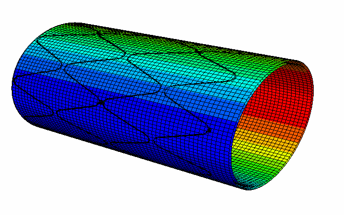 Optimizing Performance: FEA Medical Stent simulation with Abaqus vumat subroutine